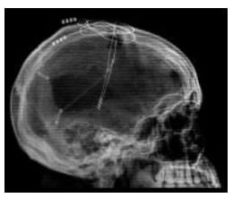 Investigadores de España y EE.UU. desarrollan un sensor capaz de interpretar el pensamiento