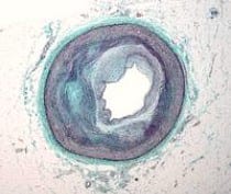 La contaminación acelera el proceso de la ateroesclerosis